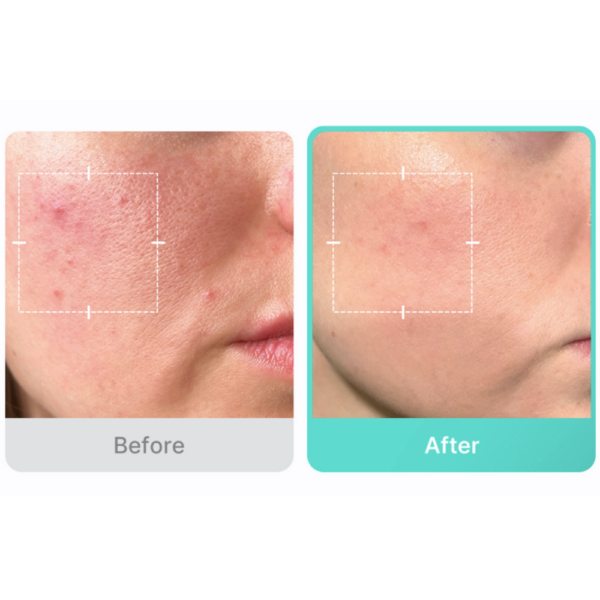Medicube Azelaic Acid 16 BB Calming Serum (30ml) - Kiyoko Beauty